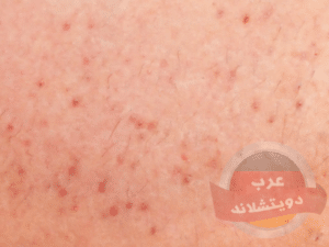 مرض الجرب بالصور