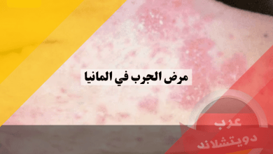 مرض الجرب في المانيا | ماهي اسباب المرض وهل هو خطير وكيفية العلاج ولماذا يزداد انتشاره ؟