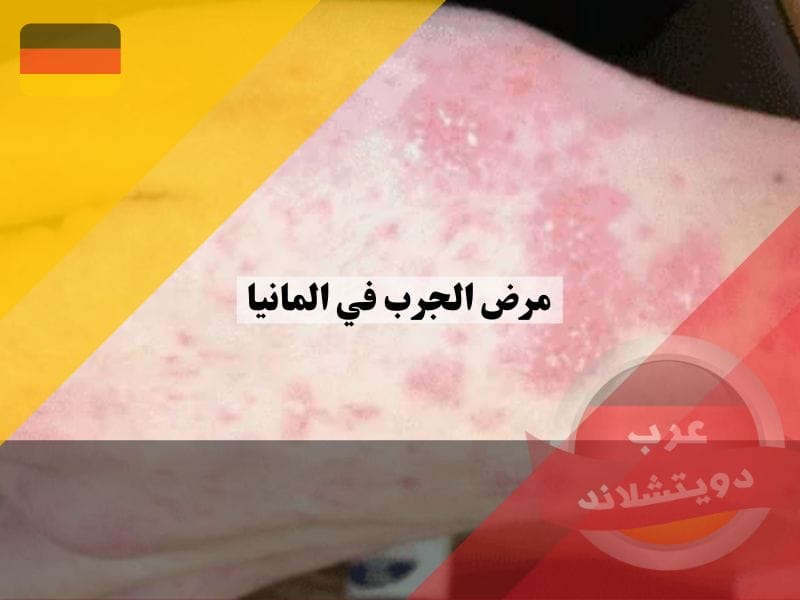 مرض الجرب في المانيا | ماهي اسباب المرض وهل هو خطير وكيفية العلاج ولماذا يزداد انتشاره ؟
