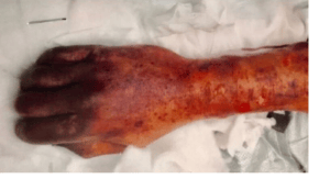 بثور على يد عجوز ستيني