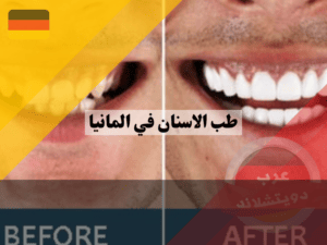كم تكلفة تبييض ابتسامة هوليود في المانيا