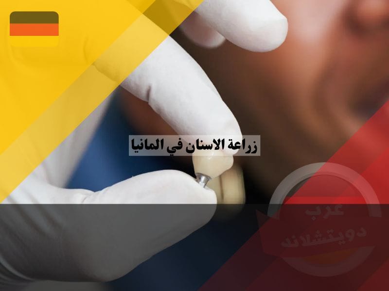 مميزات وعيوب زراعة الاسنان في المانيا