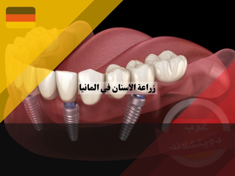 زراعة الاسنان في المانيا